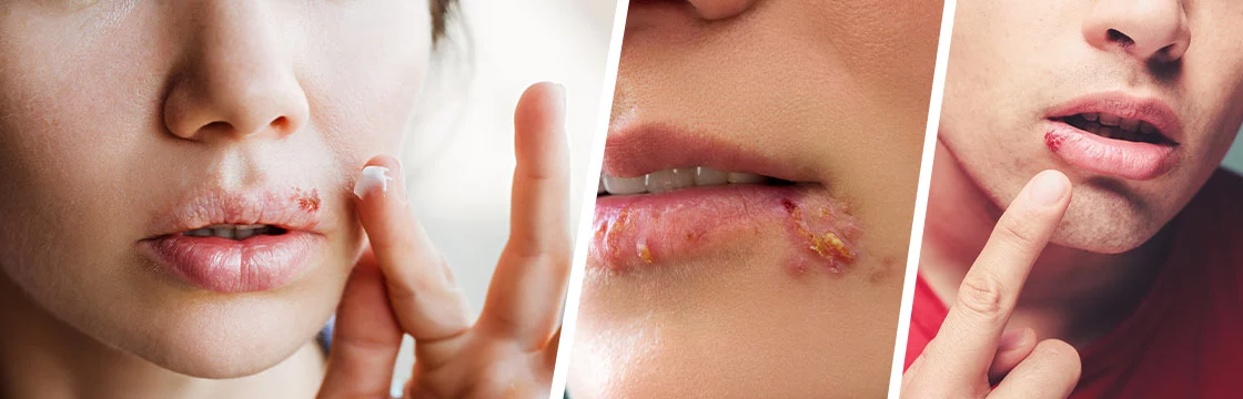Iahas-Cold Sores-herpes labialis
