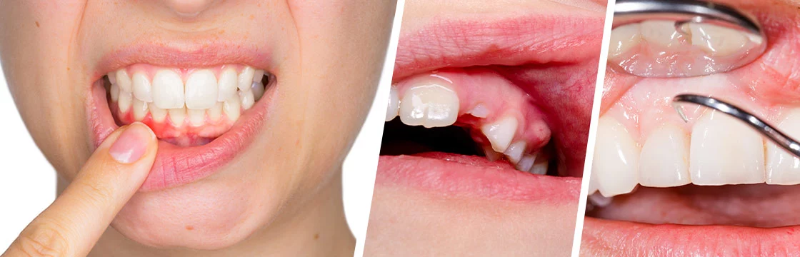 Iahas-Teeth and Gums—Ayurvedic Care