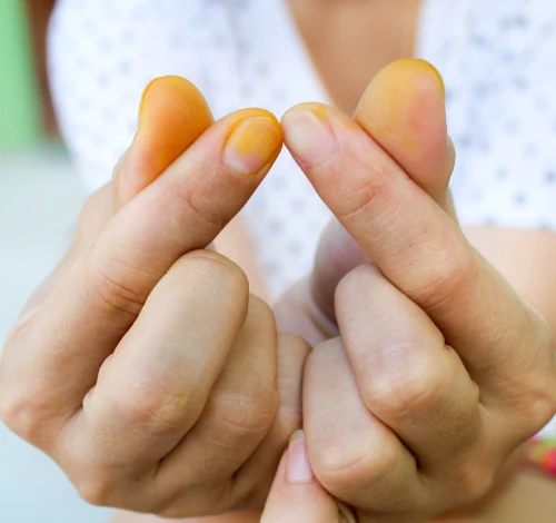 Iahas-turmeric-stain-on-hand-image